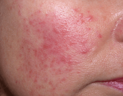 Woman with acne on the cheek.
