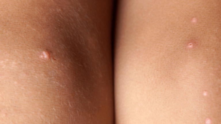 Can You Get Acne On Your Legs?