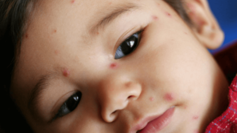 5 Years Old Child Acne – What To Do